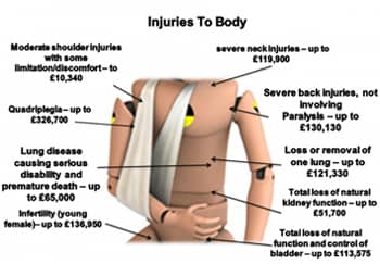 Motorcycle Injuries to Body Compensation Calculator